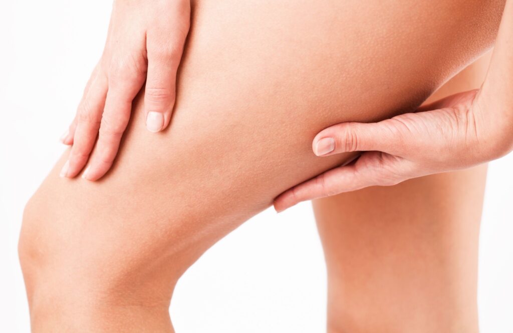 Laser Stretch Marks Treatment