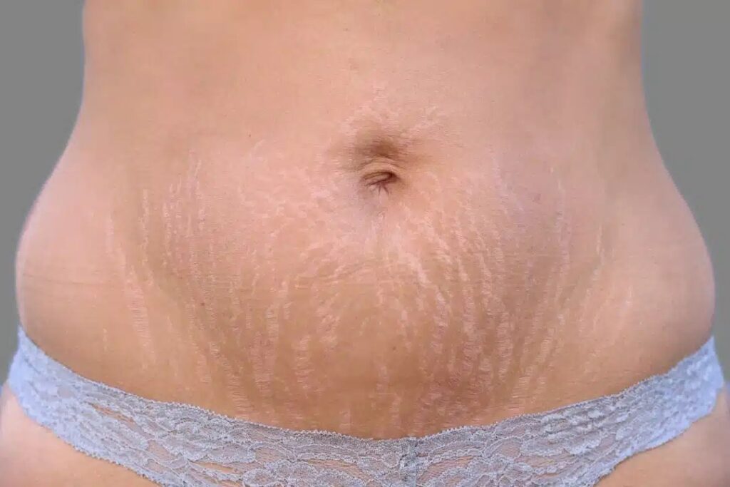 Laser Stretch Marks Treatment in Dubai