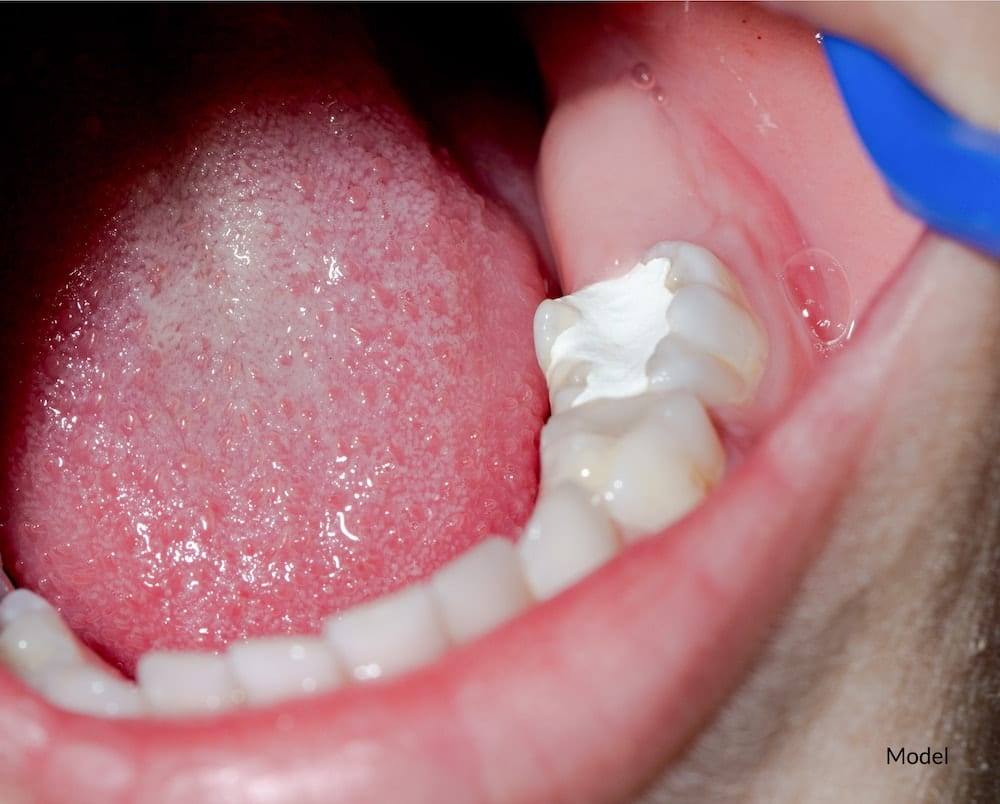Tooth Filling Cost in Dubai