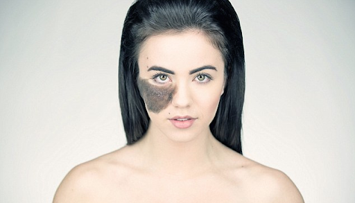 ماذا تتوقع من علاج إزالة العلامات الخلقية ؟