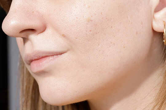 Can Laser Acne Scar Treatment Remove Fresh Acne Marks