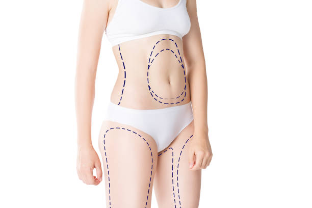 Can Liposuction Help with Belly and Waist Fat