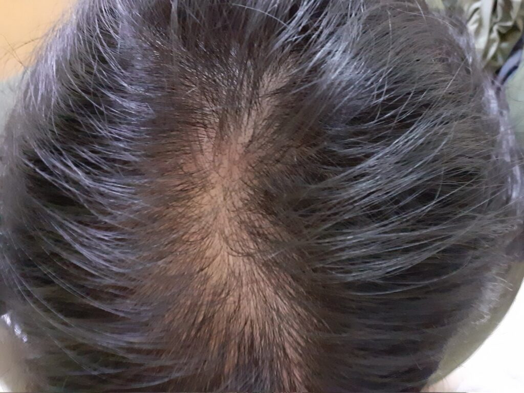 Crown Hair Transplant to Combat Thinning and Balding