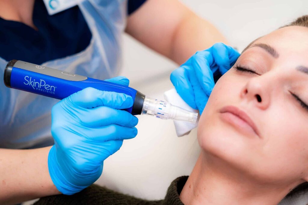 Discover the Best Laser Acne Scar Treatments