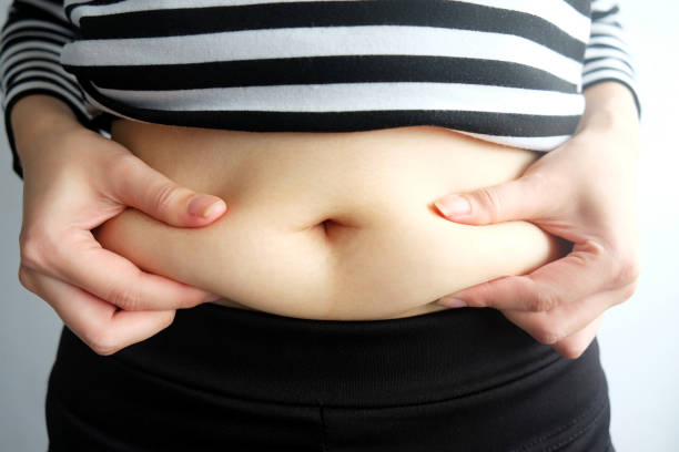 Does Tummy Tuck Provide Permanent Belly Fat Results