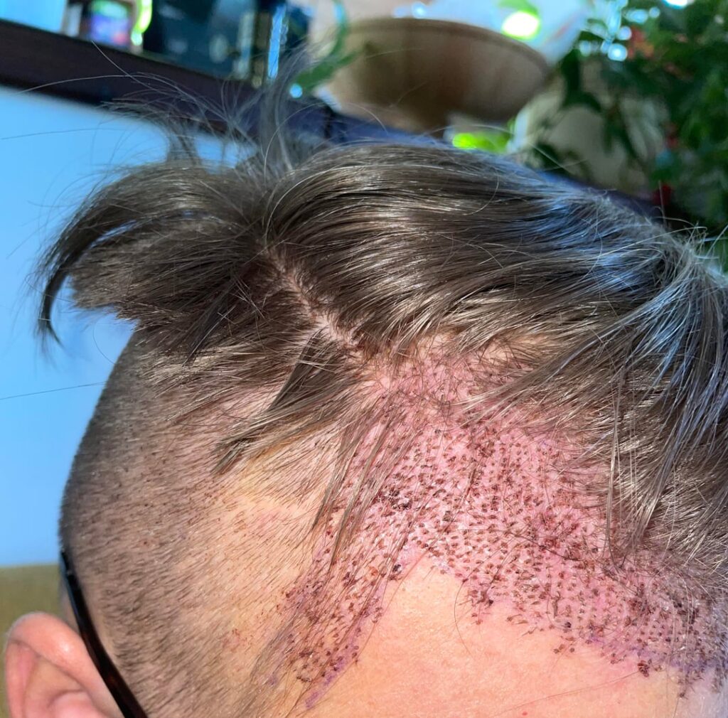 How FUE Hair Transplant in Abu Dhabi Can Transform Your Look