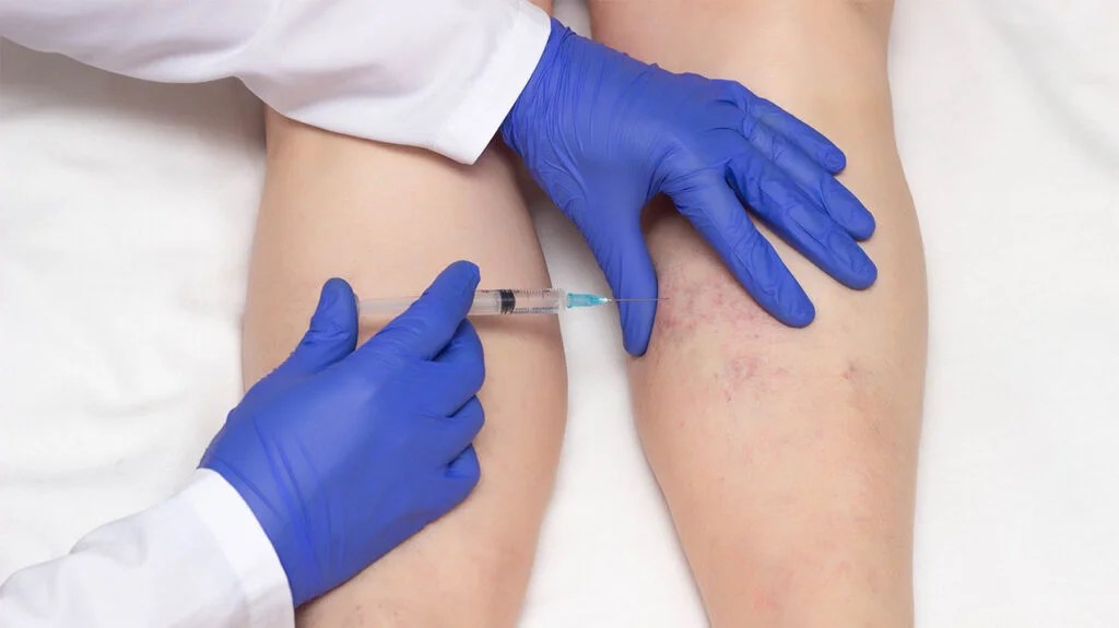 Get Rid of Spider and Varicose Veins
