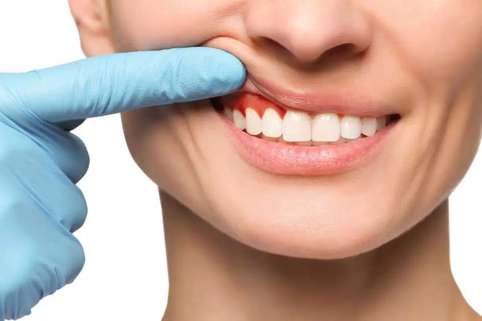 Gingivectomy for Uneven Gum Lines Smile Transformation Explained