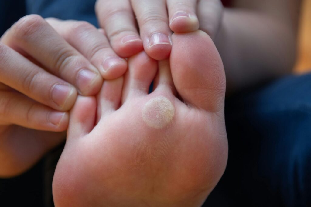 How Comfortable Is Warts Removal Treatment Now?