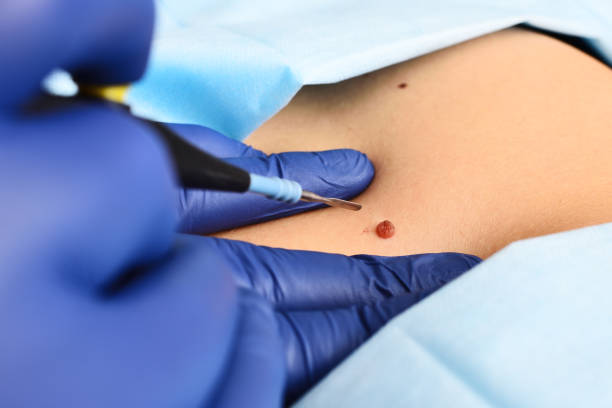 How Effective Is Mole Removal for Large Moles