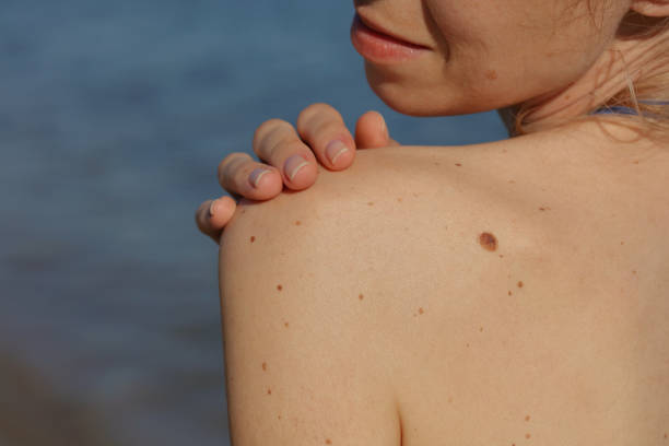 How Effective is Benign Mole Removal Treatment for Large Moles