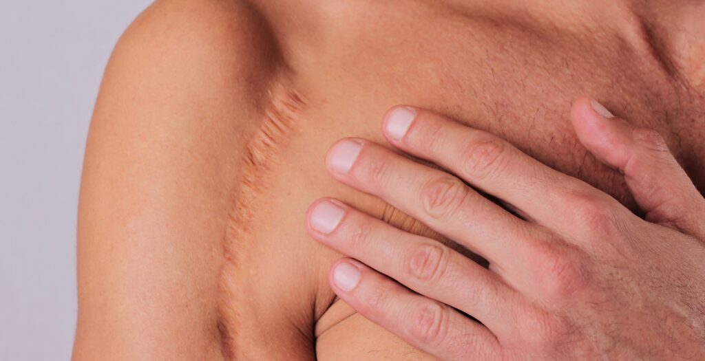 How Surgical Scar Revision Helps with Keloid Scars