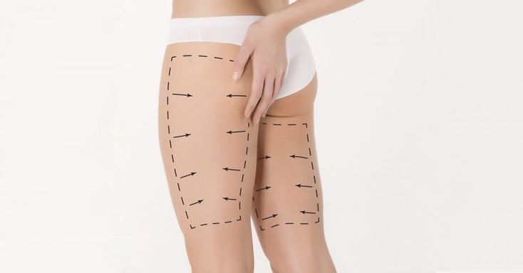 How Thigh Lift Improves Overall Body Contour Shape