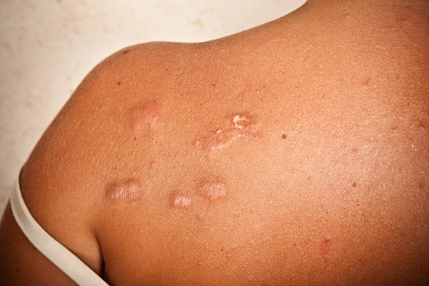 Is Keloid Treatment Safe for Darker Skin Complexions