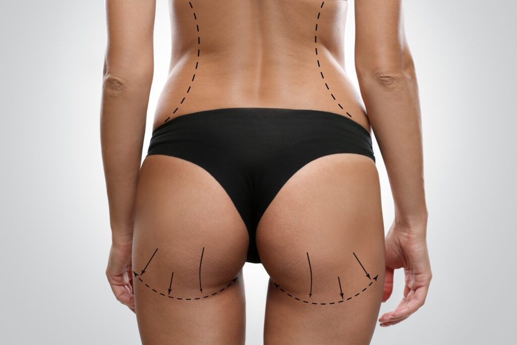 Is a Plastic Surgeon Right for Buttock Augmentation?