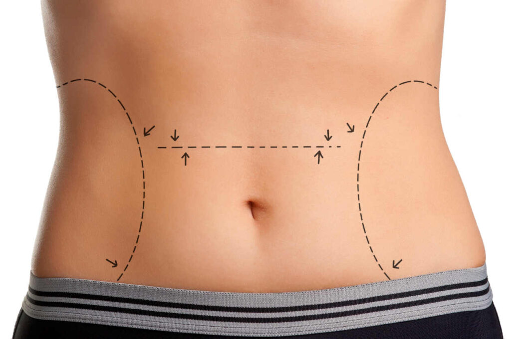 Restore Your Pre-Pregnancy Body with a Tummy Tuck