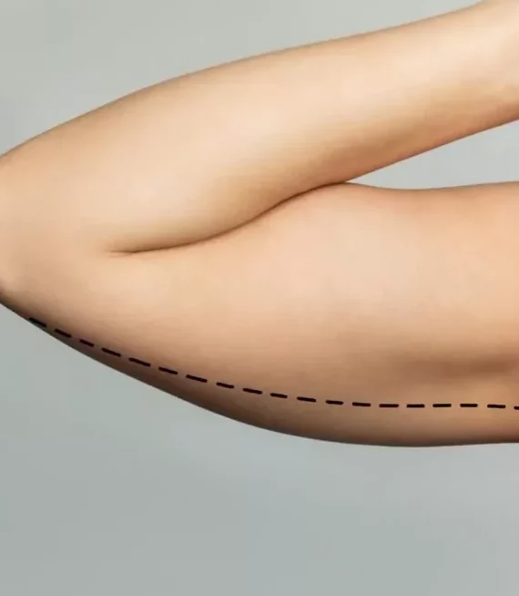 The Ultimate Guide to Arm Lift Treatments
