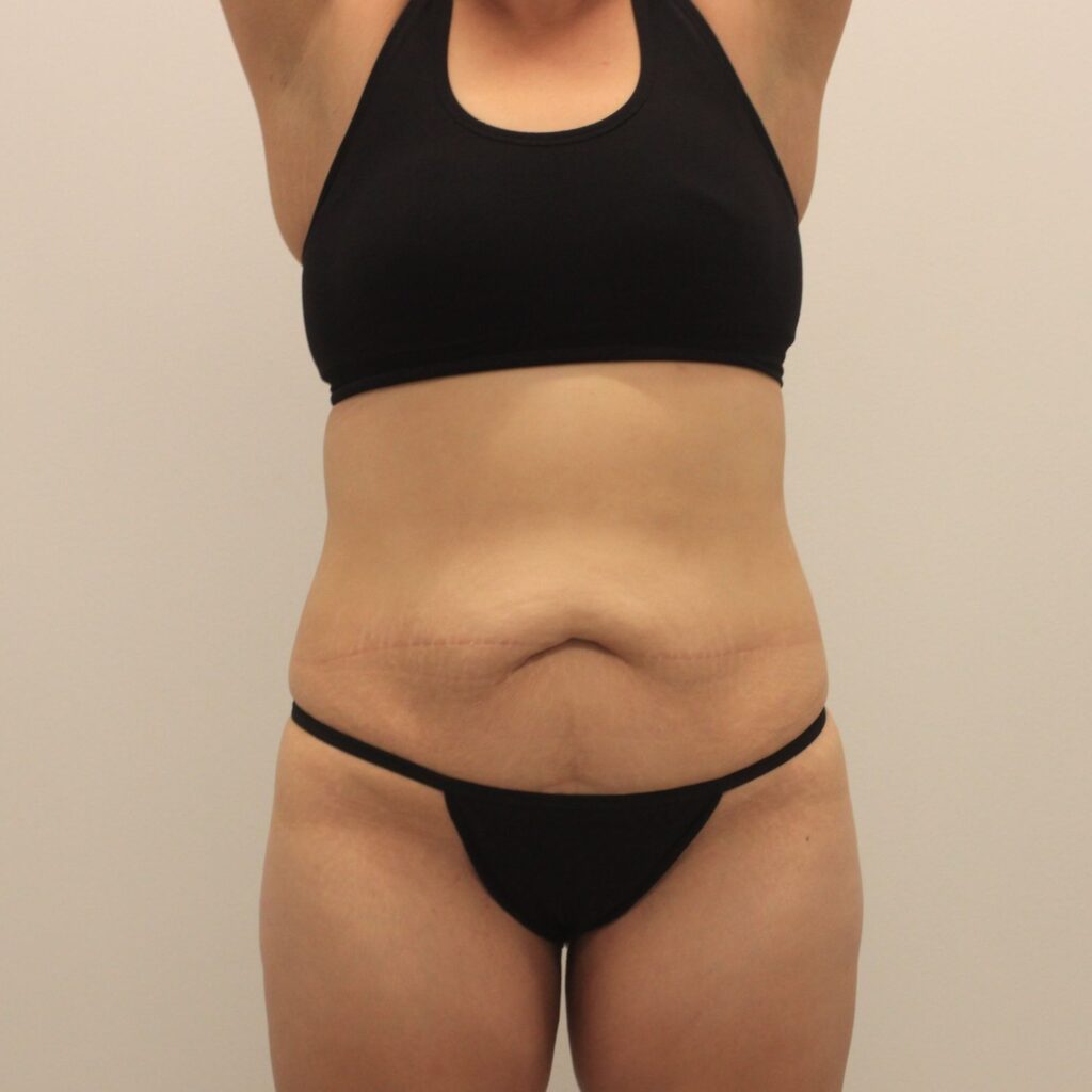 The Ultimate Guide to Mini Abdominoplasty