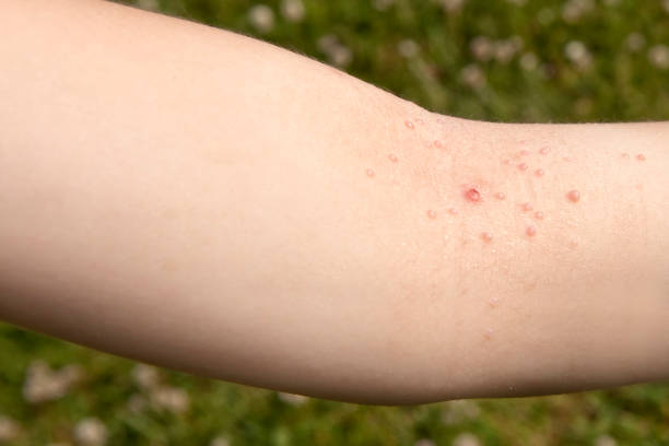 What to Expect After Warts Removal Treatment Session