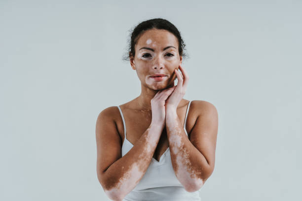 Why Vitiligo Treatment is a Trusted Skin Solution
