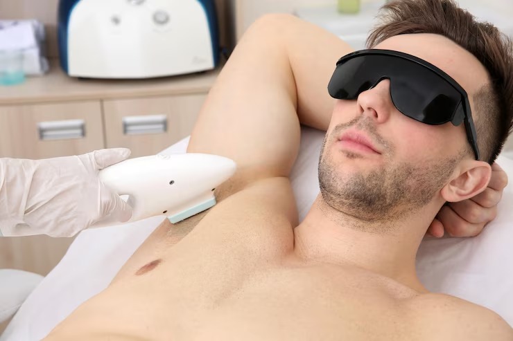 Male Laser Hair RemovaL