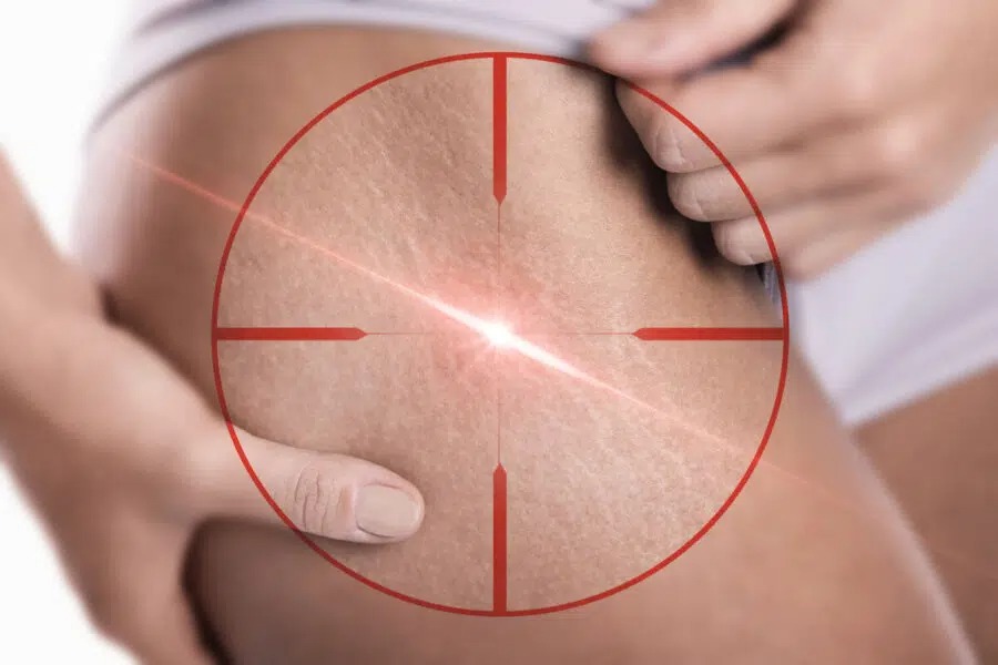 Laser stretch marks treatment