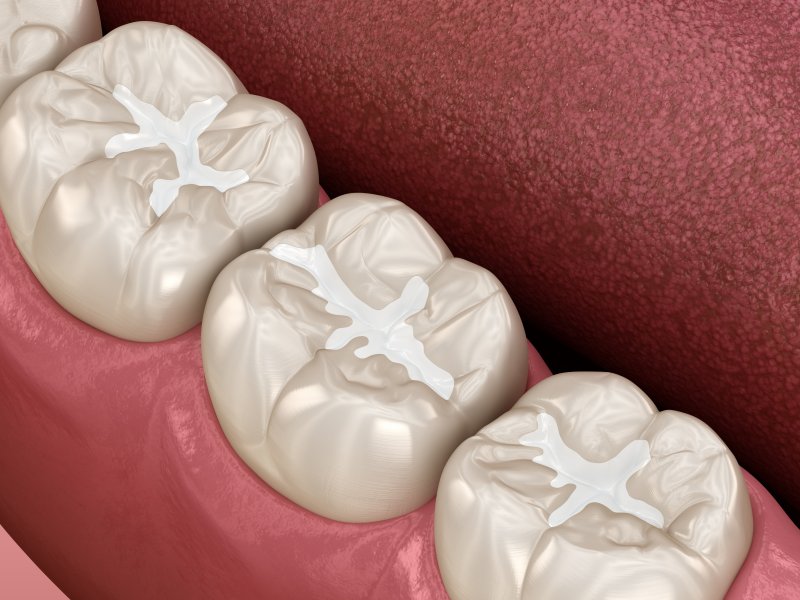 Dental Tooth Filling in Dubai