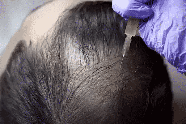 Is PRP Hair Treatment Better Than Hair Medicines