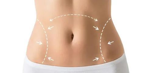 Tummy Tuck Surgery in Riyadh