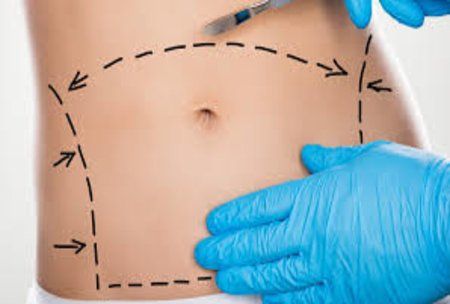 Tummy Tuck Surgery in Riyadh