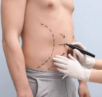 Tummy Tuck Surgery in Riyadh