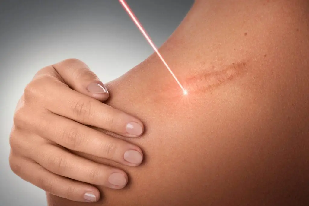 Preparing for Your First Laser Stretch Marks Treatment Session