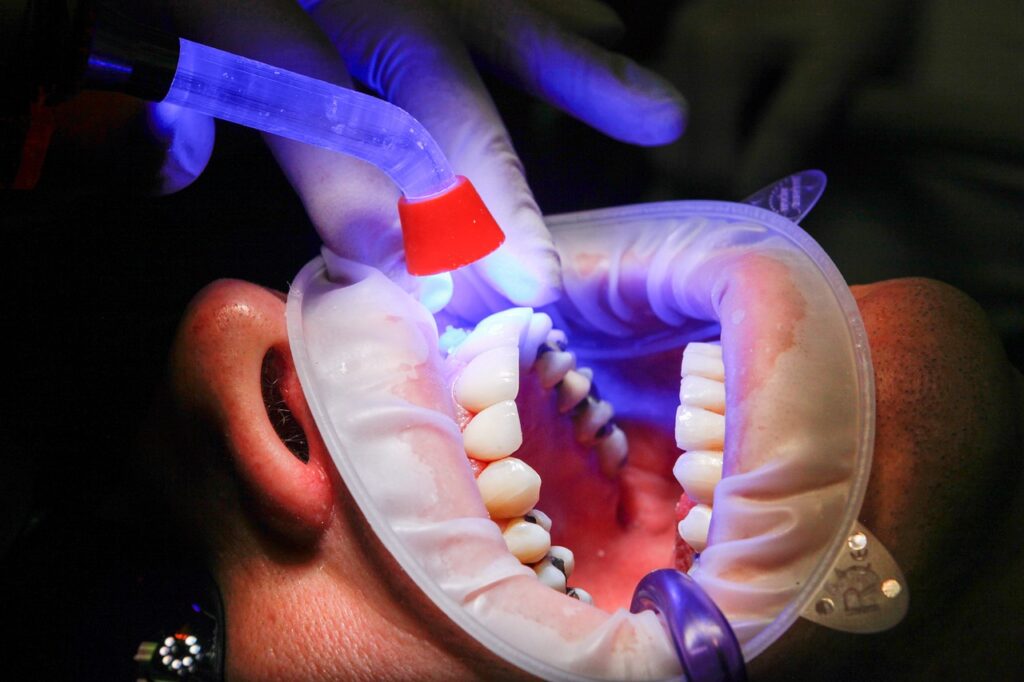 dentist, facet, uv light, curing, teeth, mouth, treatment, uv lamp, patient, clinic, dentist, dentist, dentist, dentist, dentist, teeth-1864921.jpg