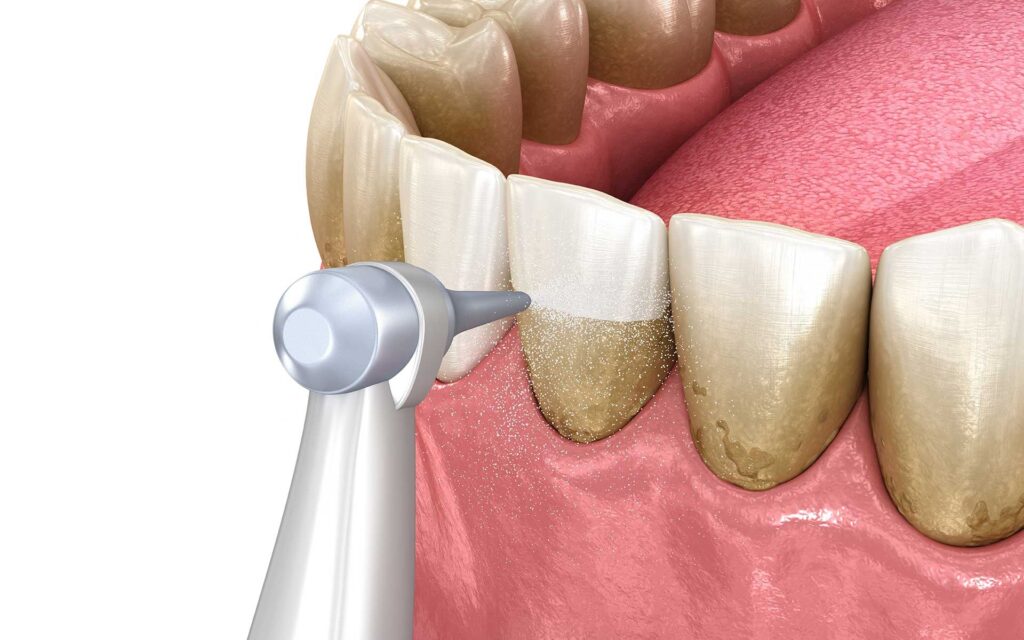 Teeth Cleaning in Dubai
