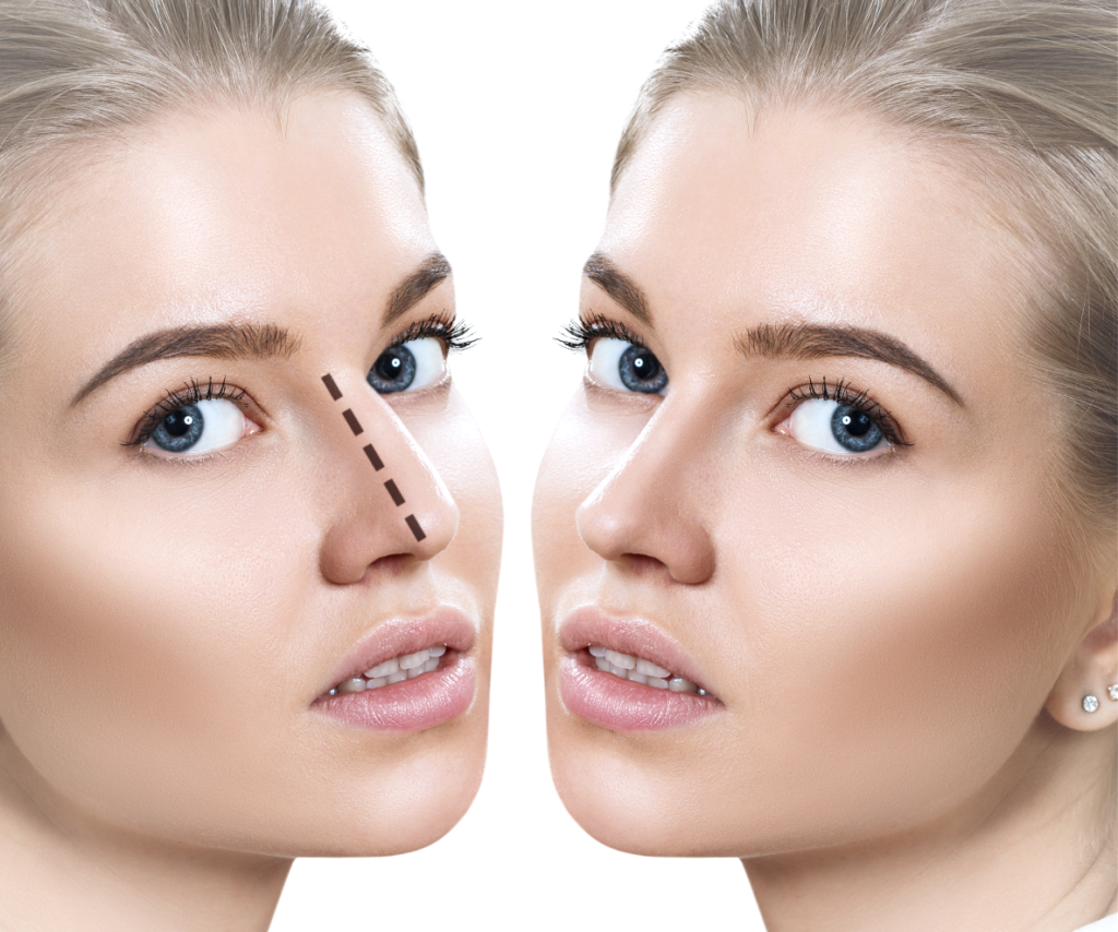 Rhinoplasty