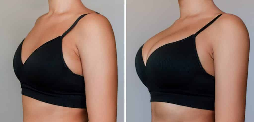 Breast Lift