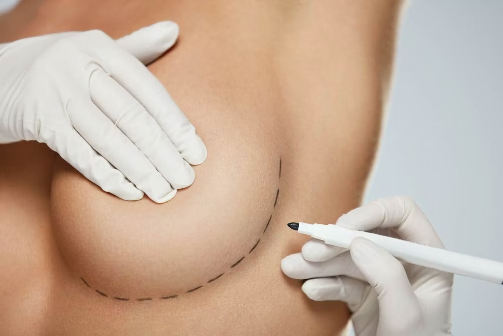 Breast Lift