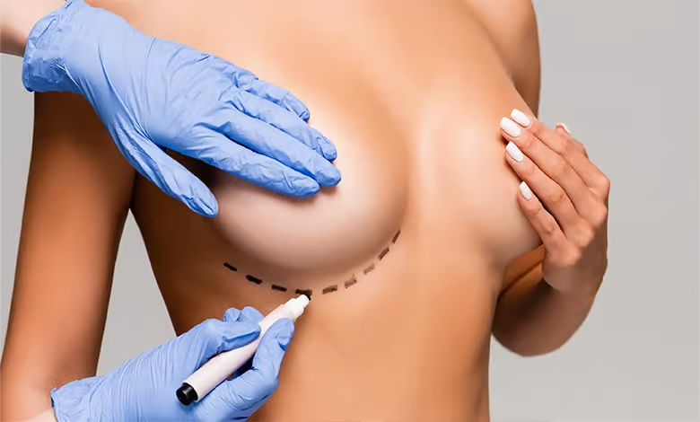 Breast Lift