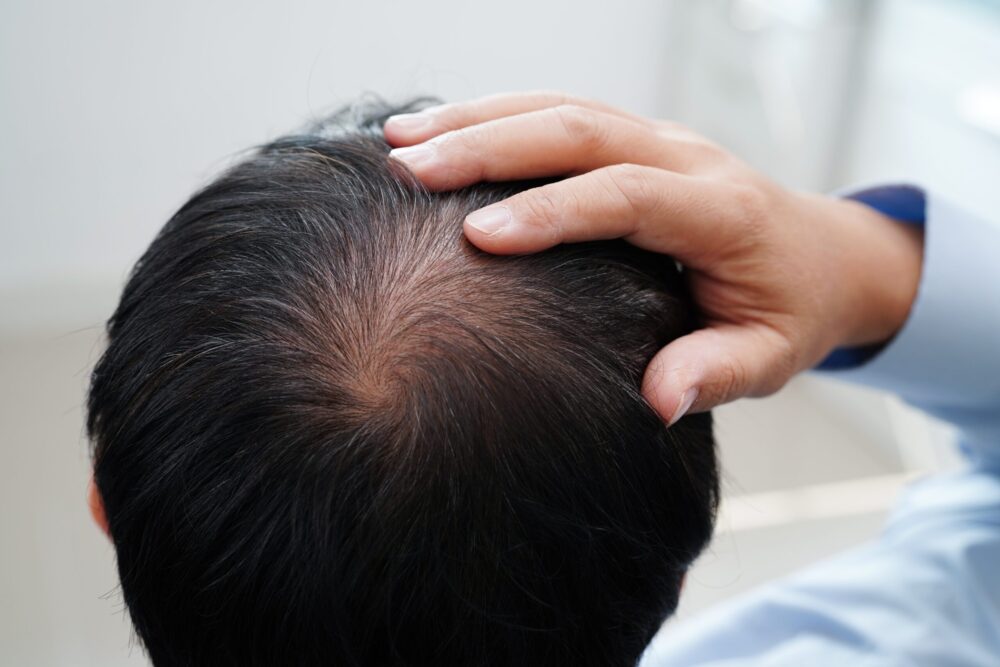 Finasteride 1mg Price and Its Role in Hair Restoration