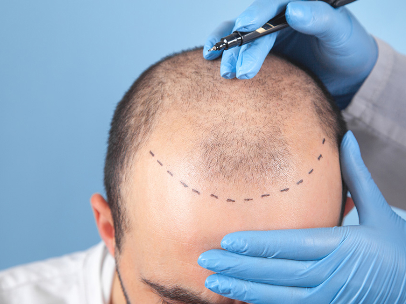 Advanced Techniques for Crown Hair Transplants in Abu Dhabi