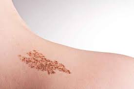 Reliable solutions for birthmark correction