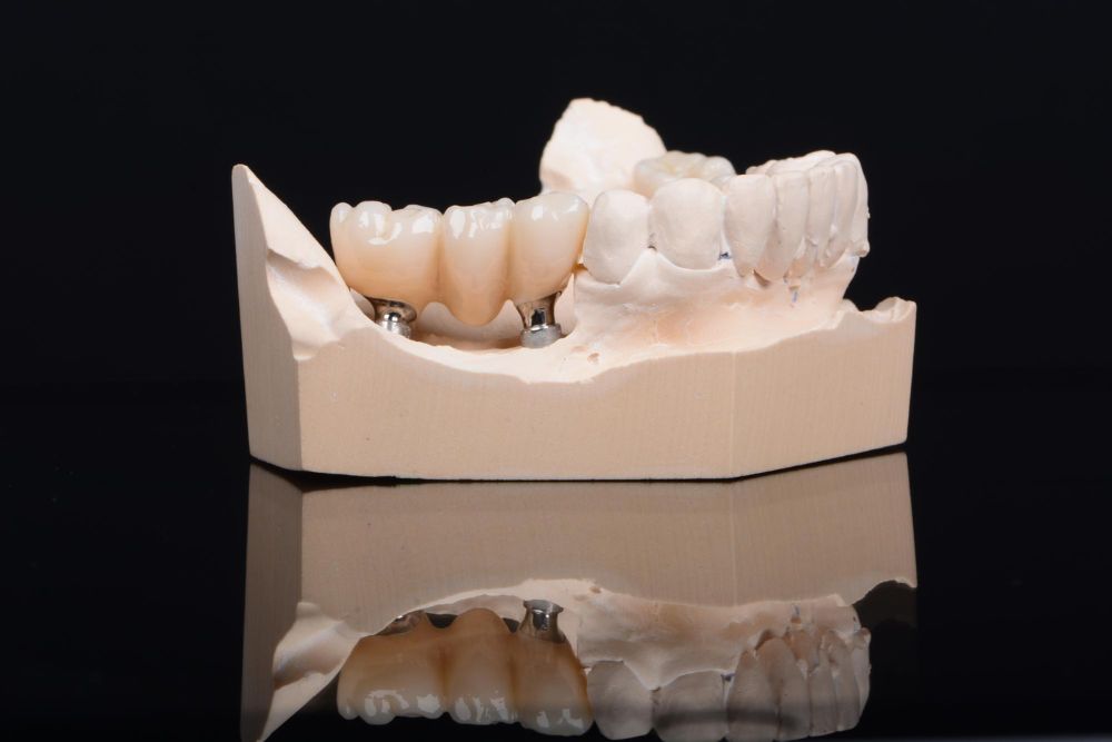 Dental Crowns and Bridges for Missing Teeth: Your Options