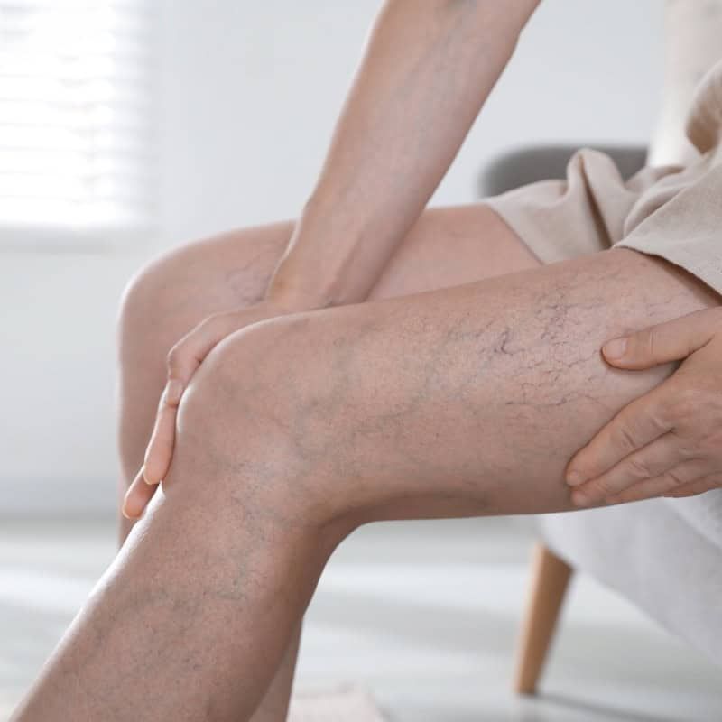 Varicose Veins Treatment in Riyadh
