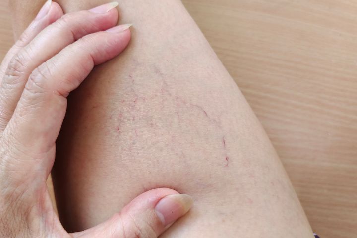 Varicose Veins Treatment in Riyadh