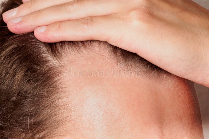 How Long Does Front Line Hair Fixing Last?