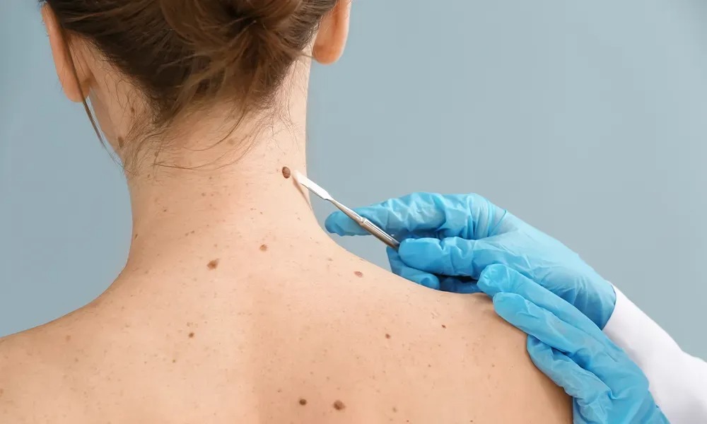 Skin Tag Removal in Dubai