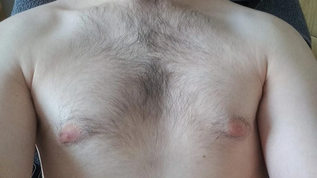 Body Hair Transplant in Dubai