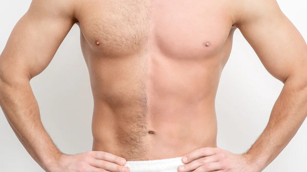 Body Hair Transplant in Dubai