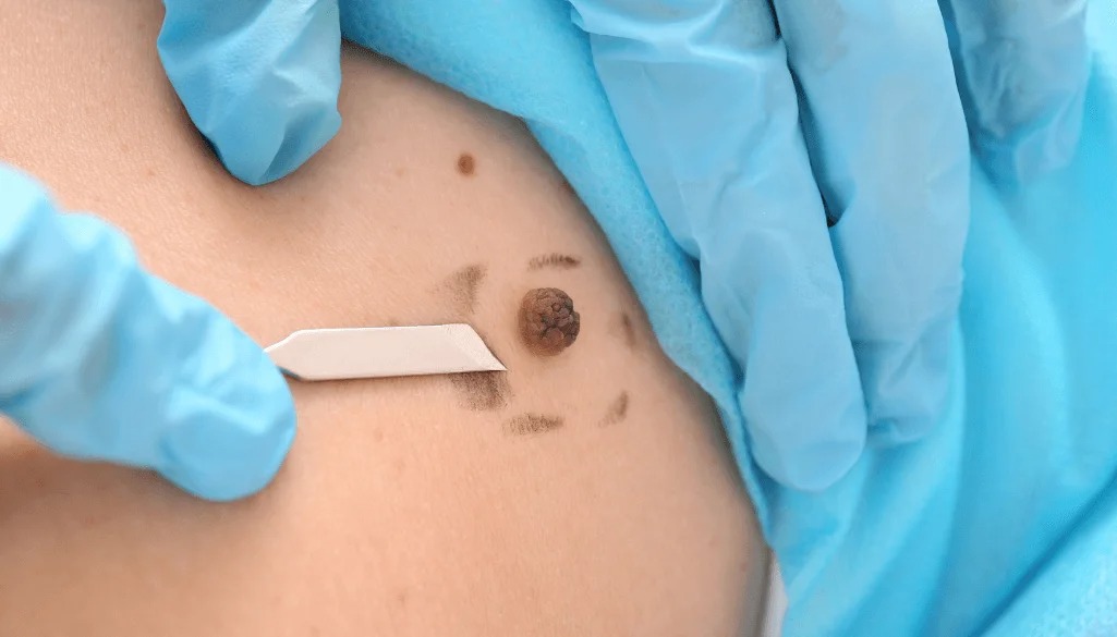 Skin Tag Removal in Dubai