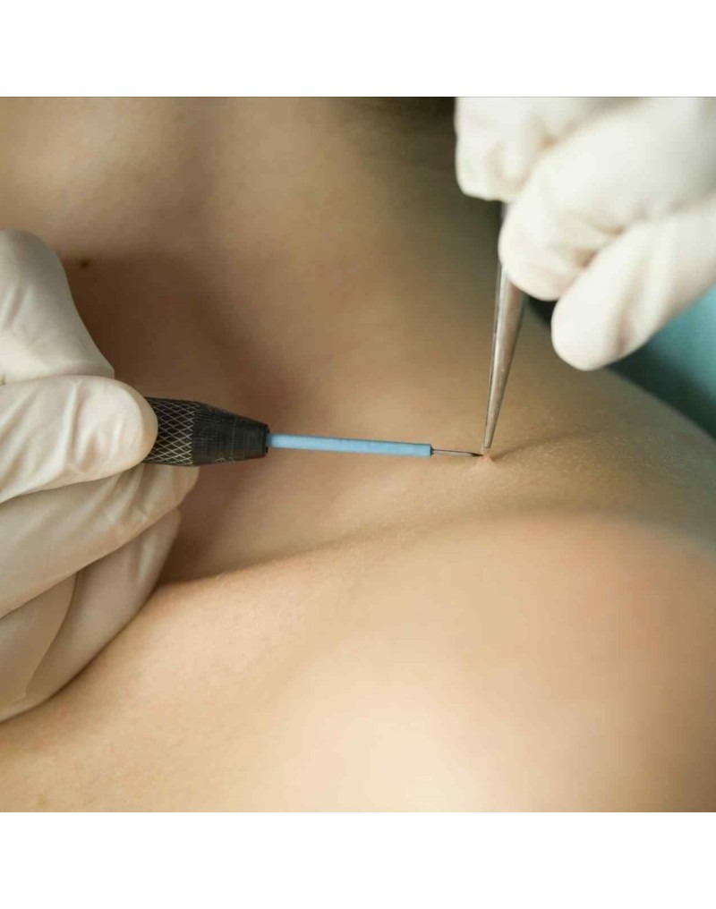 Skin Tag Removal in Dubai